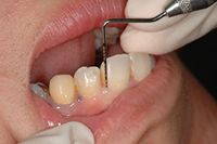 歯科健診　歯周病検査
