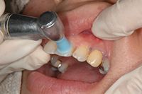 歯科健診　歯面研磨